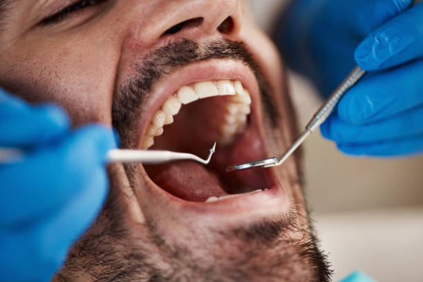 Best Emergency Dental Care for Abscessed Tooth in Pioneer, CA